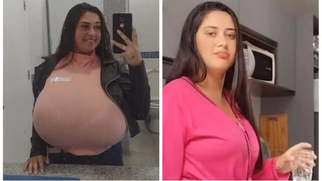 From Burden to Bravery: Thaynara Marcondes’ Journey Through Gigantomastia and Recovery